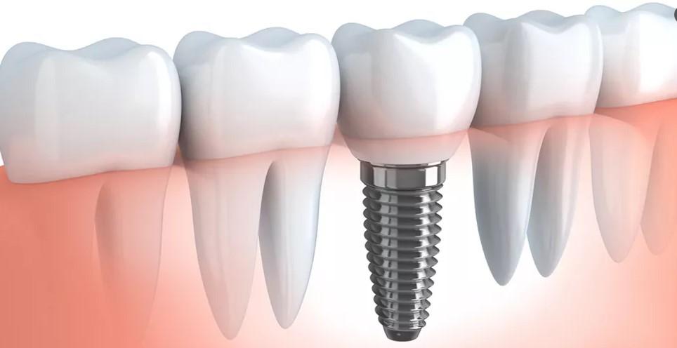دكتور محمد عصفور يوضح الفرق بين الزراعه والتركيبات وايهما افضل
