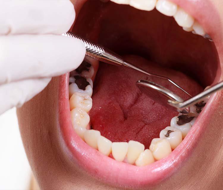 علاج تسوس الأسنان ومراحله المختلفة