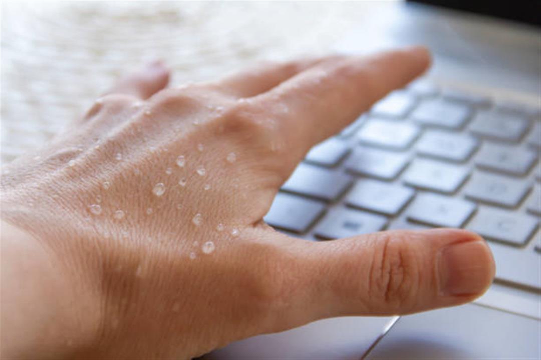 Hyperhidrosis of hands