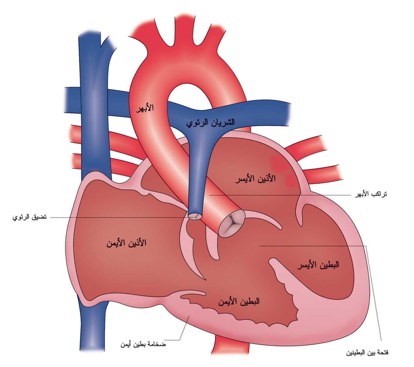 أحادي البطين: الخطة الجراحية