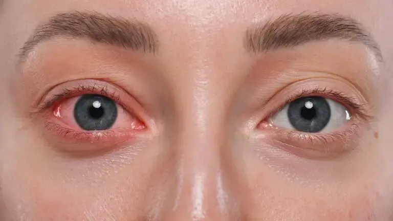 التهاب العين: متى يكون خطيرًا