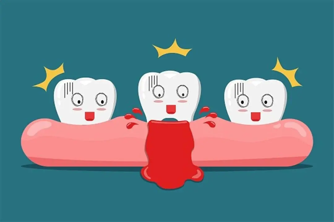 نزيف اللثة أثناء تنظيف الأسنان وعلاج التهاب اللثة في التجمع الخامس