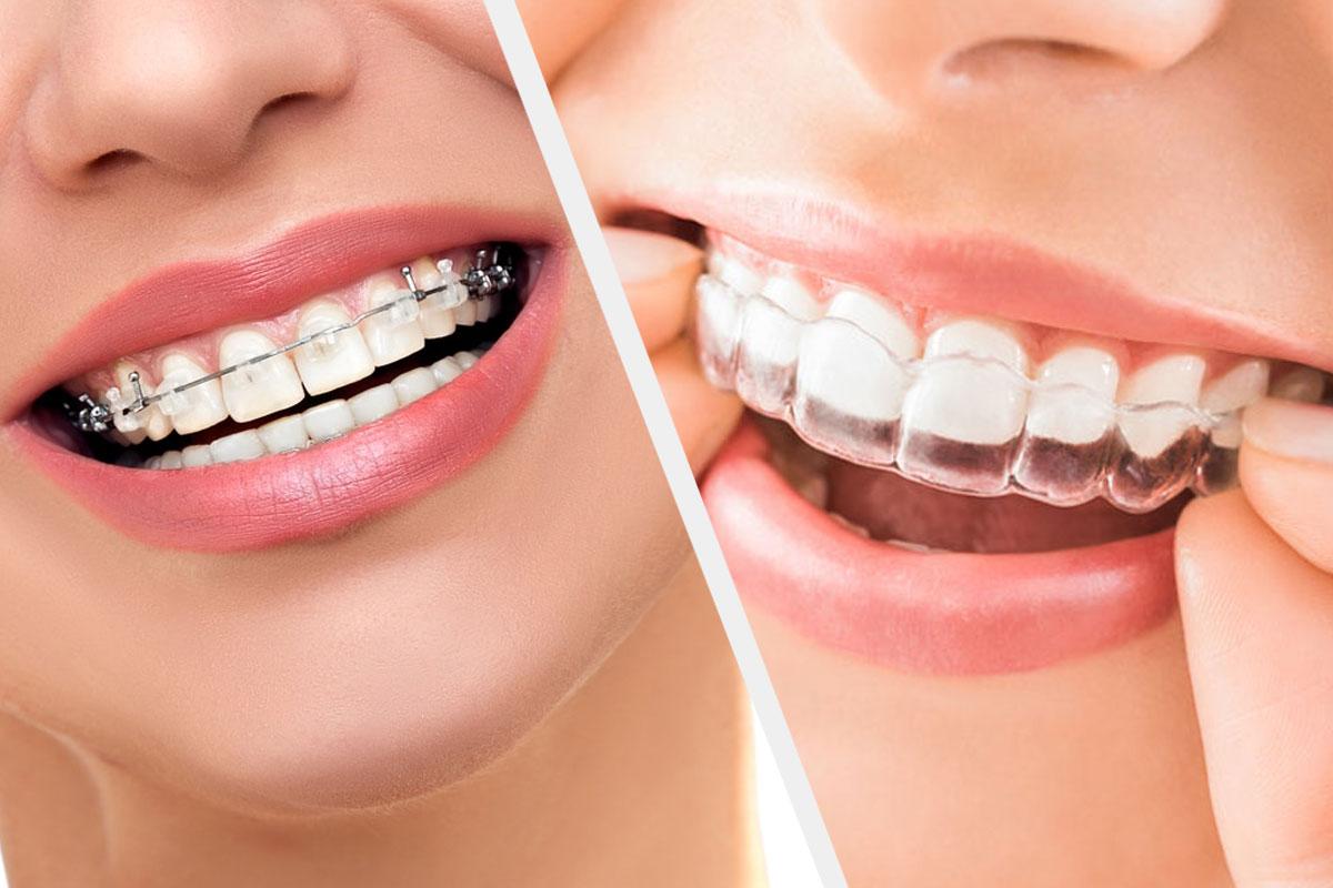 Metal Braces Orthodontic Treatment
