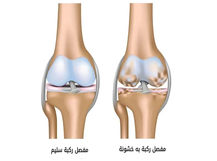 Knee osteoarthritis causes and joint pain illustration
