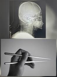 حادثة طبية نادرة لرجل عاش بعود معدني داخل حلقه لسنوات