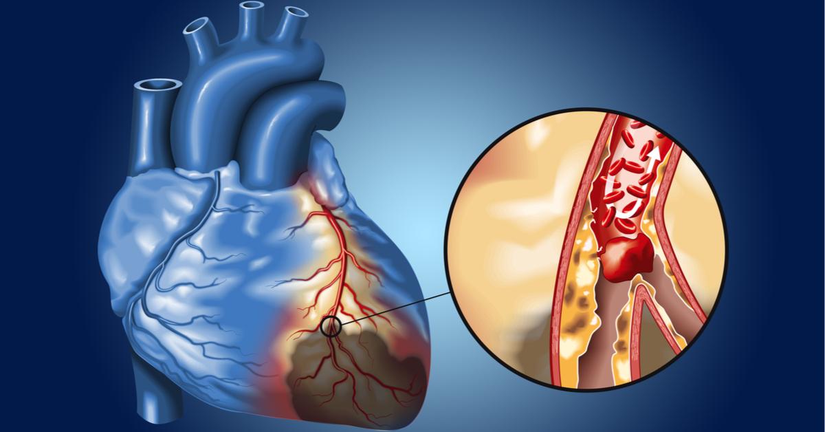 Coronary artery narrowing illustration