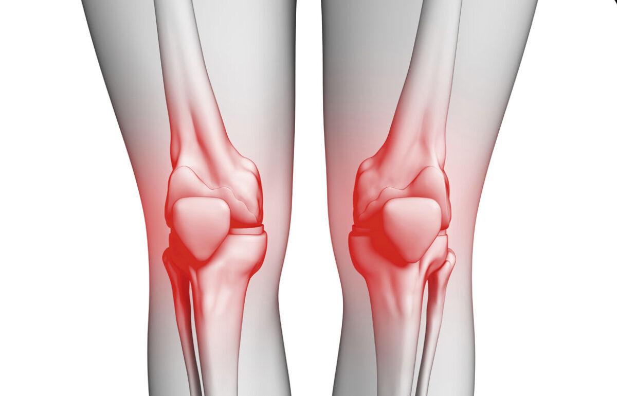 Knee osteoarthritis symptoms with pain and stiffness