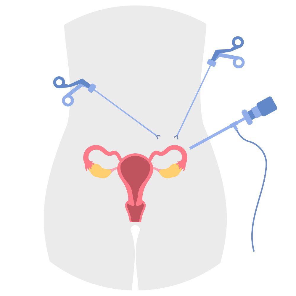 Laparoscopic hysterectomy surgery in Assiut