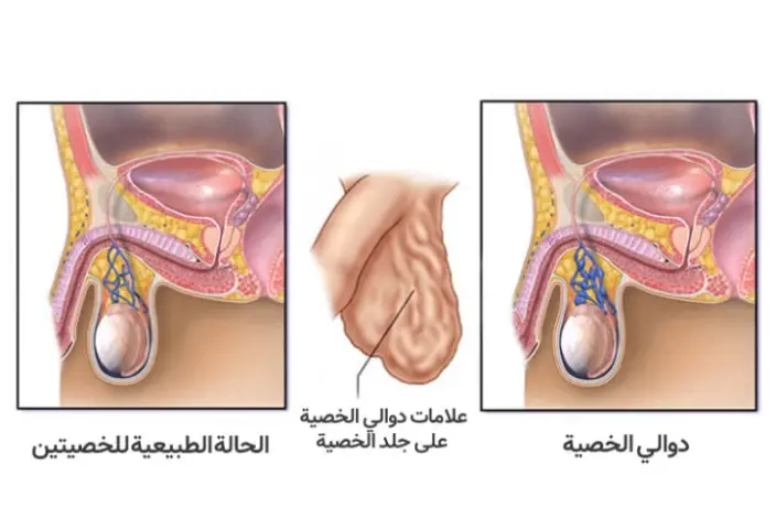دوالي الخصية