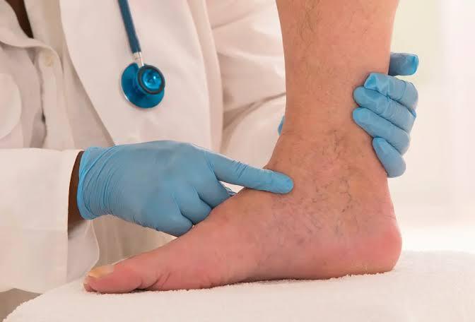 علاج دوالي الساقين بالليزر في شبرا الخيمة
