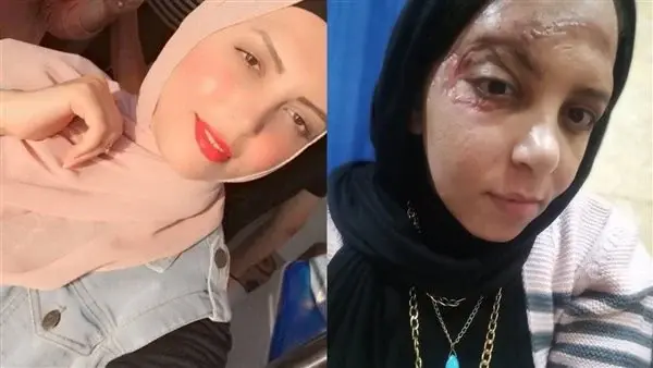 فتاة برج العرب بعد الحادث وقبله