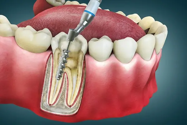 علاج جذور الأسنان