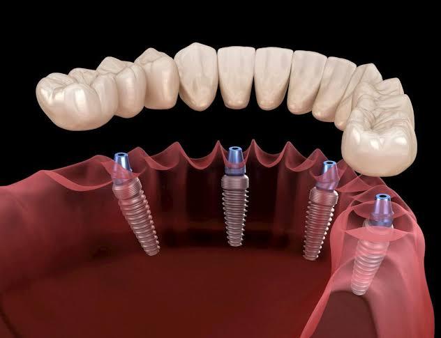 Dental Implants in Sharqia with Dr. Ahmed Hamdy Amer