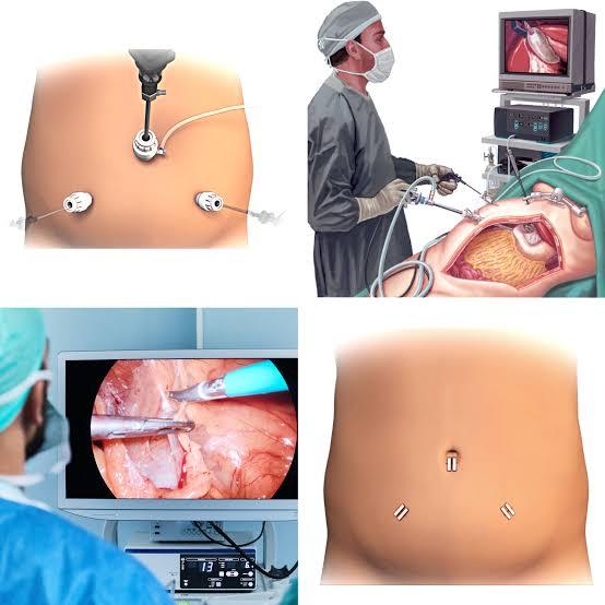 Laparoscopic Surgery in Mohandessin with Dr. Mohamed Mansour Kamel