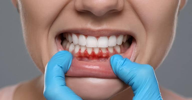 Gum treatment in Mohandessin
