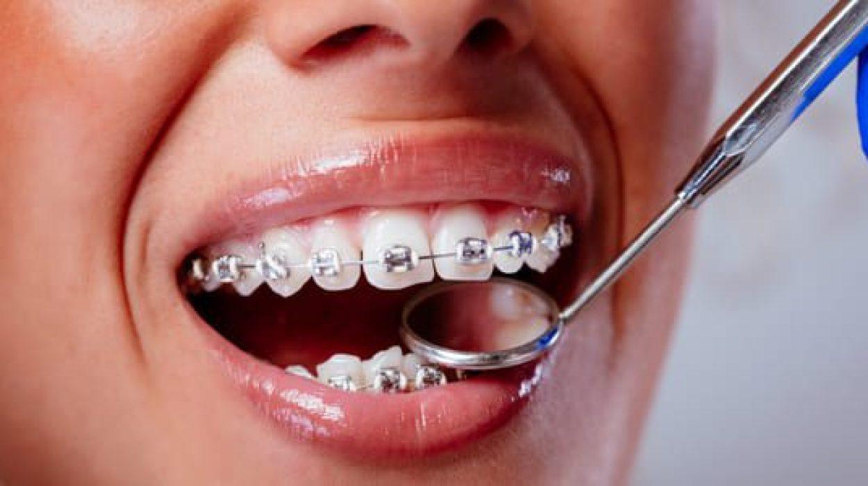 Orthodontic treatment in Kafr El Sheikh at A Plus Center