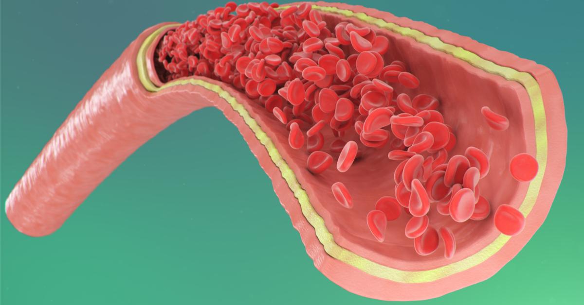 Symptoms of coronary artery insufficiency in Dokki