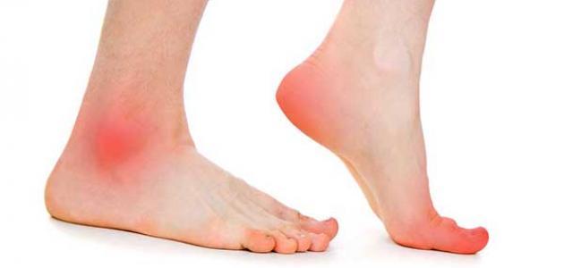 Doctor for flat feet and pes planus treatment in Alexandria