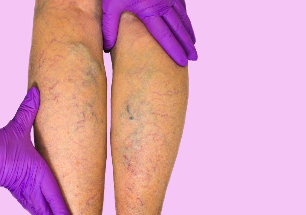 Laser Treatment for Varicose Veins in Shubra El Kheima &ndash; Dr. Mohamed Mansour Kamel