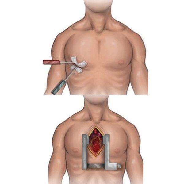 إعادة تأهيل بعد جراحات القلب