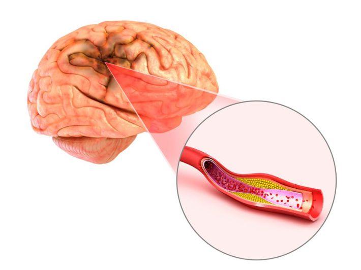 Neurologist in Helmeyet El-Zeitoun Neurologist for stroke assessment in Helmeyet El-Zeitoun