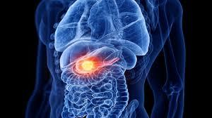 دراسة طبية تكشف مخاطر عودة سرطان البنكرياس بعد التعافي