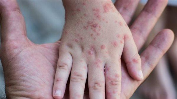 ارتفاع إصابات الحصبة في أمريكا وفترة الحجر الصحي