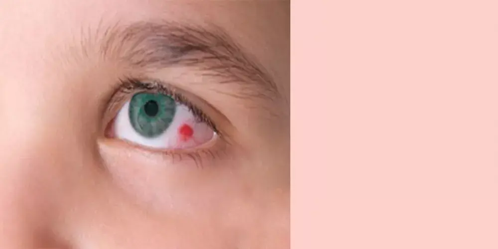  بقعة دم في بياض العين