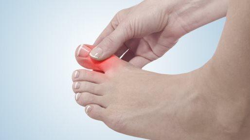 ارتفاع إصابات النقرس بين الشباب تحت سن الأربعين