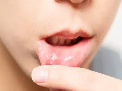 قرح الفم قد تكون علامة لمشكلات صحية كامنة