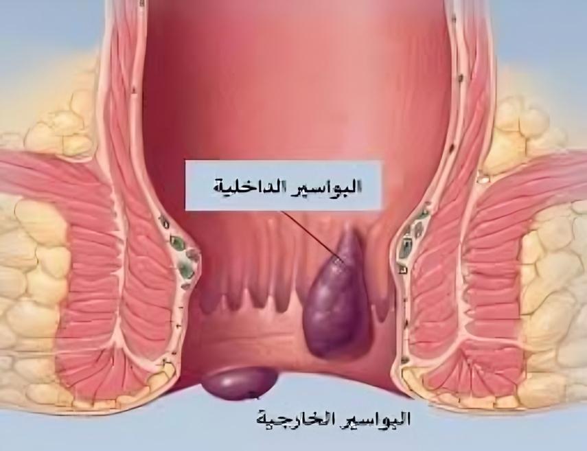 علاج البواسير مع د. عصام الشاعر