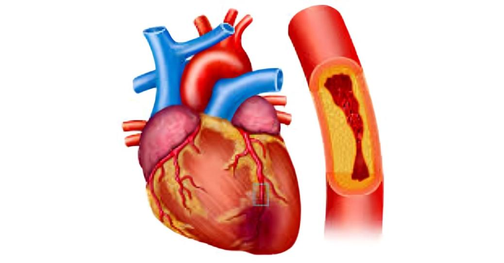 مراض الشرايين التاجية