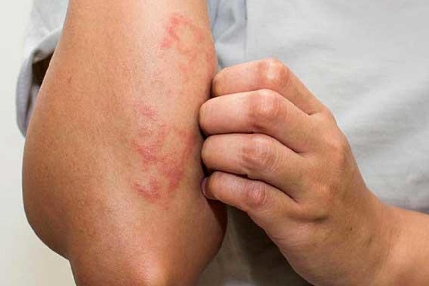 علامات مبكرة لحساسية الطعام