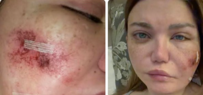 ياسمين الخطيب تتوقف عن تصوير أعمالها بعد إصابة بكتيرية في الوجه