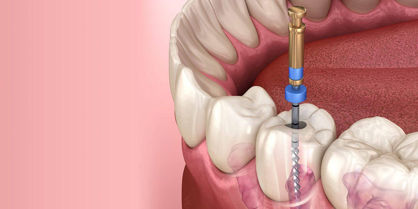 Root Canal Treatment