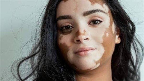 مريض بهاق قبل وبعد استخدام كريم روكسوليتينيب مع تحسن واضح في لون البشرة