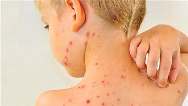 تفشي الحصبة في أمريكا والمكسيك وقلق الخبراء الصحيين