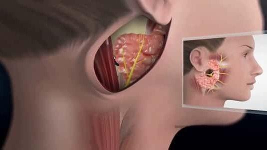 طفل يعاني من تورم في الخدين بسبب النكاف مع نصائح لتشخيص المرض مبكرًا.