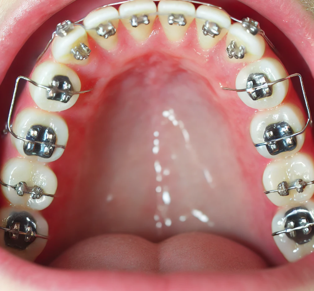 التقويم الداخلي من خلف الأسنان