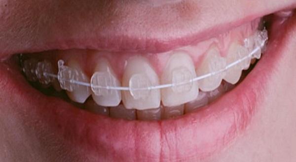 تقويم الأسنان السيراميك الأقل وضوحًا