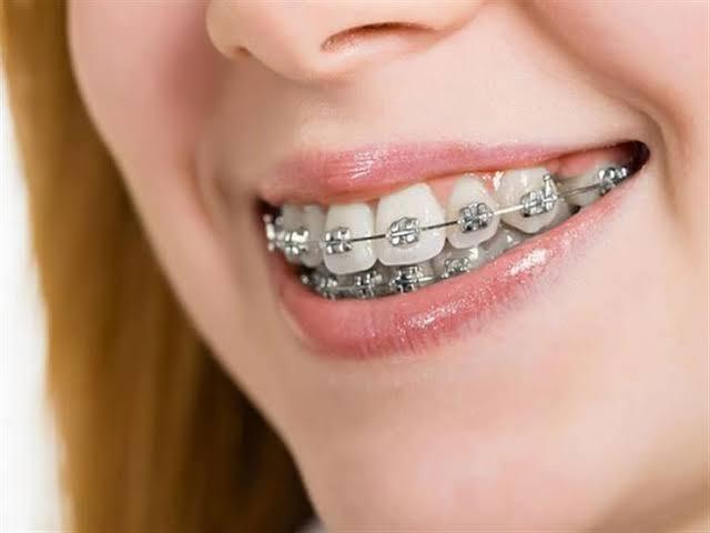 تقويم الأسنان في الإسكندرية