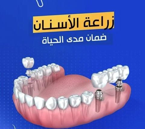زراعه الاسنان ضمان مدي الحياه