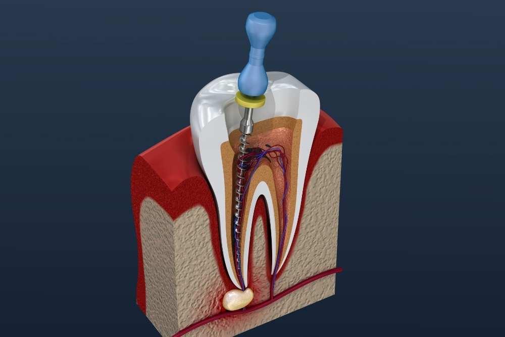 Root Canal Treatment in Nasr City Root Canal Treatment in Nasr City