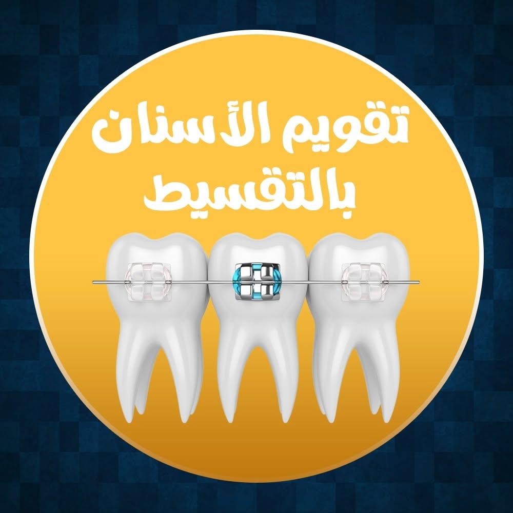 تقويم الأسنان بالتقسيط