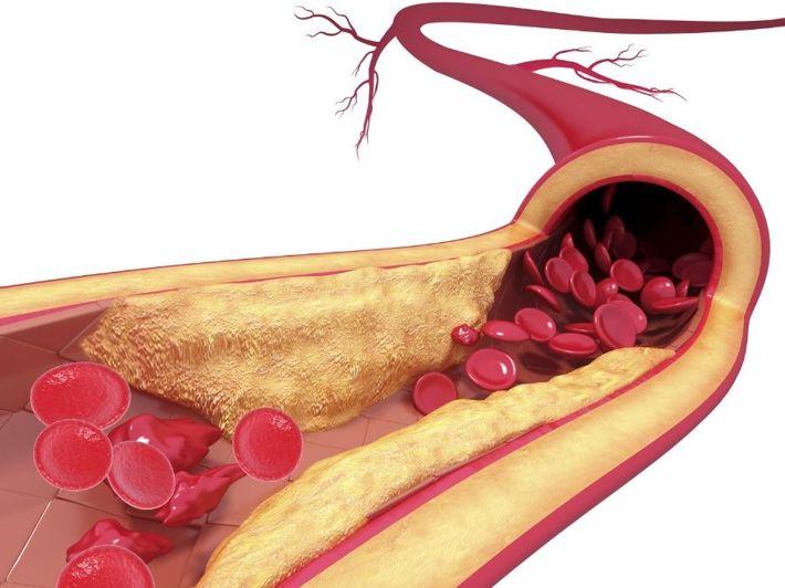 Treatment of Arterial Blockage