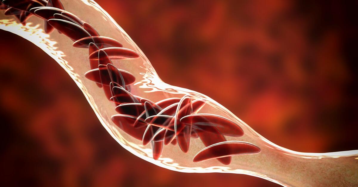 Chronic Anemia and Iron Deficiency Anemia Chronic Anemia and Iron Deficiency Anemia Treatment