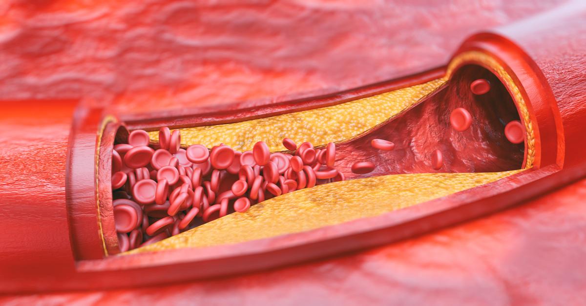 Atherosclerosis Treatment Atherosclerosis Treatment