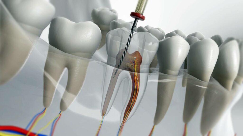 Root Canal Treatment in New Damietta - Dr. Menna Morsi El Sayed