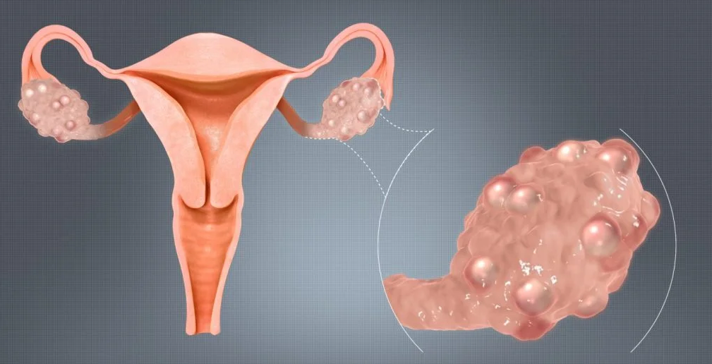 Ovarian Cyst Treatment