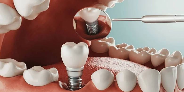 Dental Implant Dental Implant